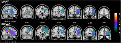 French Phonological Component Analysis and aphasia recovery: A bilingual perspective on behavioral and structural data
