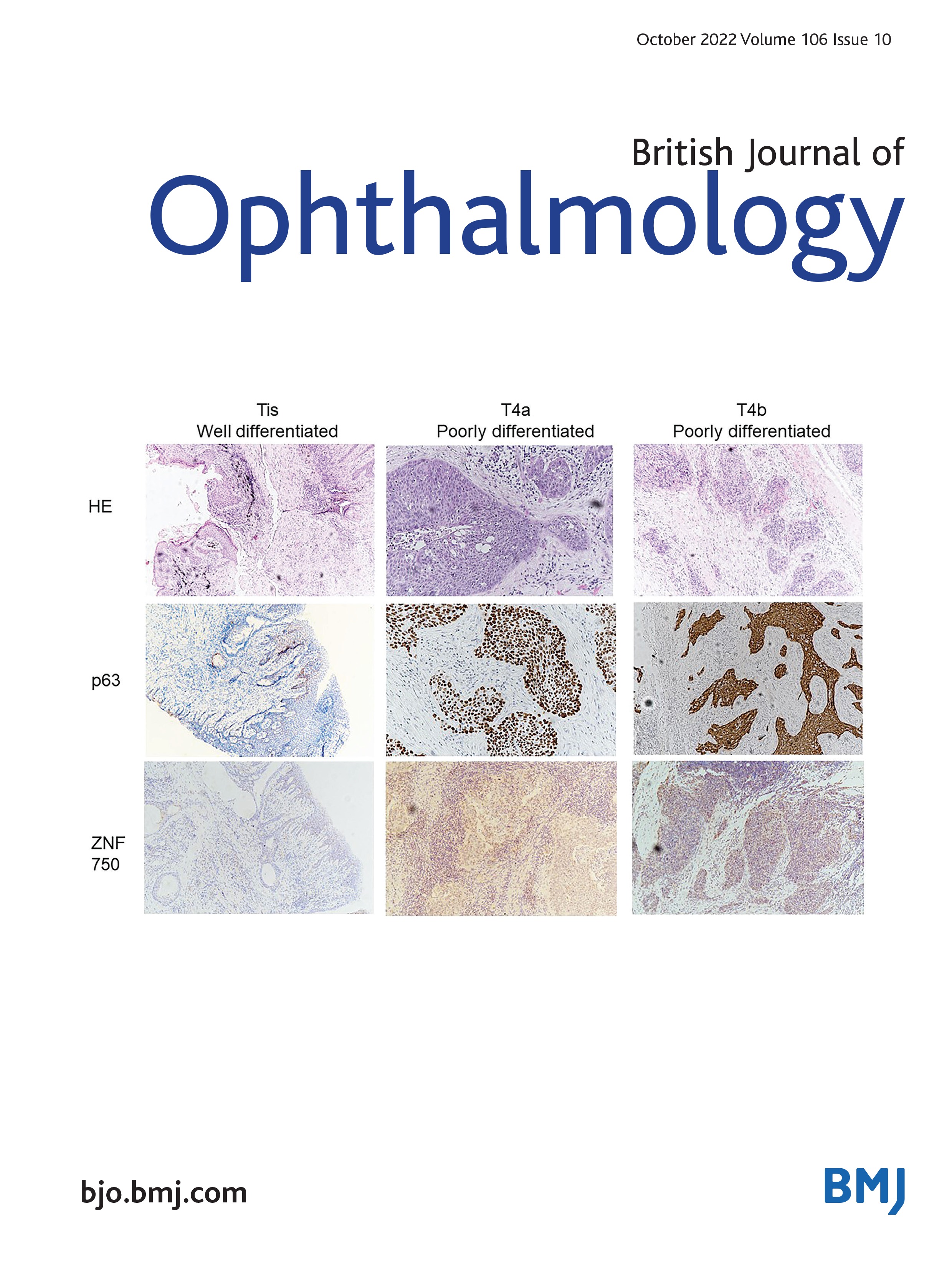 P63 expression in eyelid squamous cell carcinoma