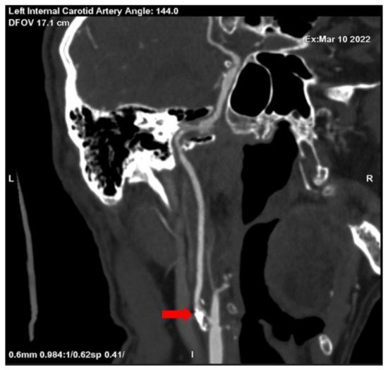 Medicina, Vol. 58, Pages 1328: The Impact of Revascularization in a Patient with Atypical Manifestations of Hypoperfusion
