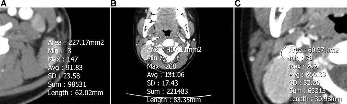 A novel diagnostic tool for hyaline vascular Castleman disease versus lymphoma based on contrast-enhanced computed tomography in neck mass