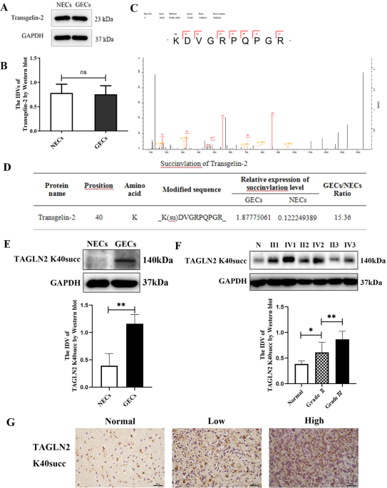 Lysine-40 succinylation of TAGLN2 induces glioma angiogenesis and tumor growth through regulating TMSB4X