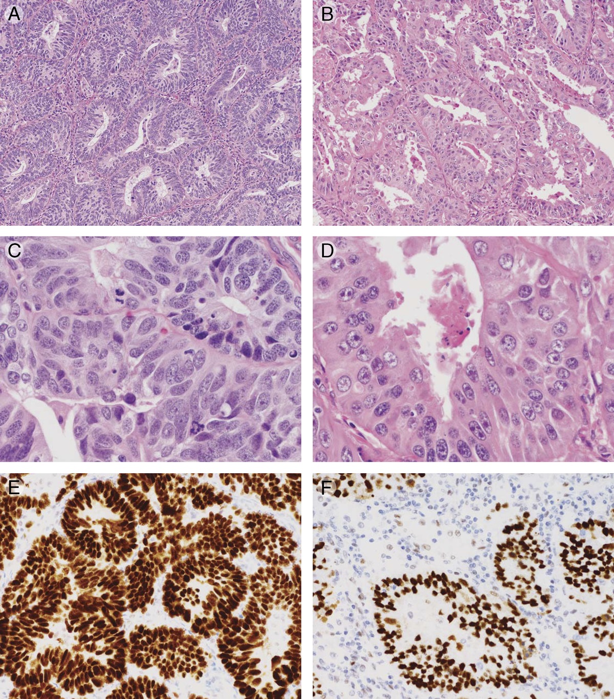 Counterpoint: Integration of Molecular Subtype and Histotype/Grade Into One Classification System for Endometrial Carcinoma