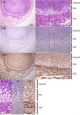 Spatial multiomic profiling reveals the novel polarization of foamy macrophages within necrotic granulomatous lesions developed in lungs of C3HeB/FeJ mice infected with Mycobacterium tuberculosis