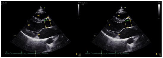 Healthcare, Vol. 10, Pages 1890: Screening of Coronary Artery Origin by Echocardiography: Definition of Normal (and Abnormal) Take-Off by Standard Echocardiographic Views in a Healthy Pediatric Population