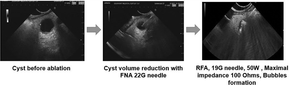 Endoscopic ultrasound-guided radiofrequency ablation of premalignant pancreatic-cystic neoplasms and neuroendocrine tumors: prospective study
