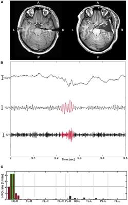 Epileptogenic high-frequency oscillations present larger amplitude both in mesial temporal and neocortical regions