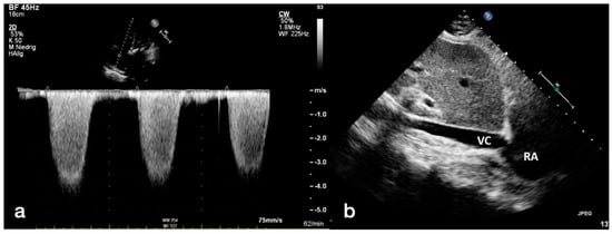 Diagnostics, Vol. 12, Pages 2363: Comparability between Computed Tomography Morphological Vascular Parameters and Echocardiography for the Assessment of Pulmonary Hypertension in Patients with Severe Aortic Valve Stenosis—Results of a Multi-Center Study