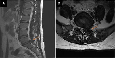Percutaneous endoscopic drainage for acute long segment epidural abscess following endoscopic lumbar discectomy: A case report