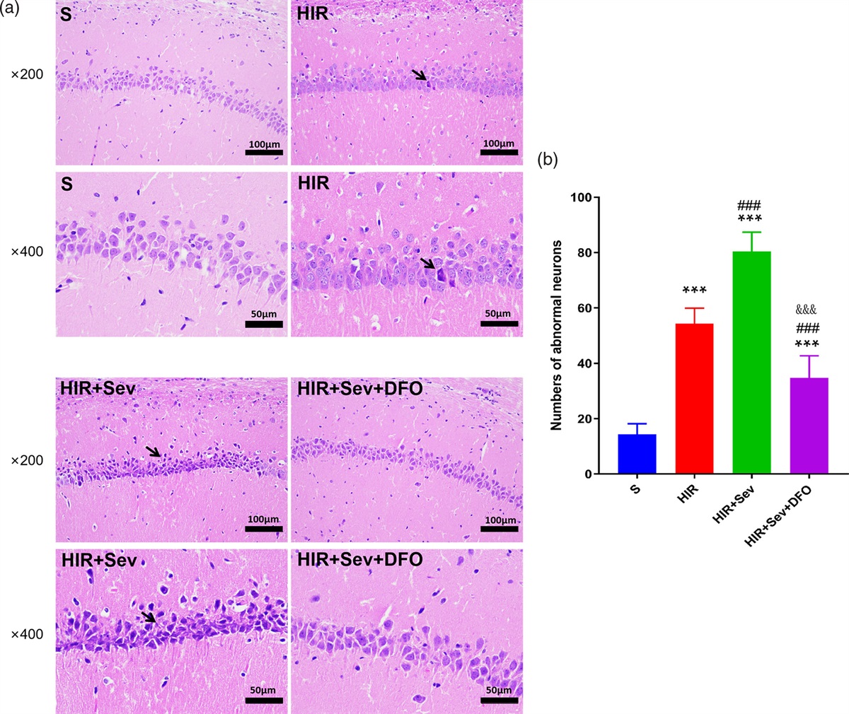 Ferroptosis involved in sevoflurane-aggravated young rats brain injury induced by liver transplantation