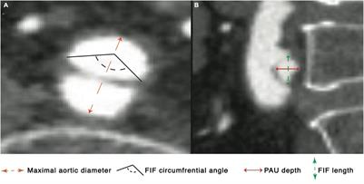 Natural history and clinical significance of aortic focal intimal flaps