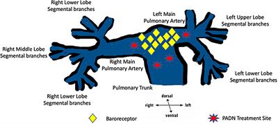 Current status of pulmonary artery denervation