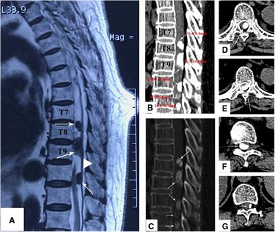 Multiple ossified spinal meningiomas in the thoracic spine: A case report and literature review