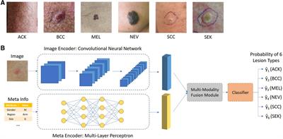 A deep learning based multimodal fusion model for skin lesion diagnosis using smartphone collected clinical images and metadata