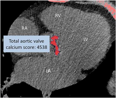 Predictors and neurological consequences of periprocedural cerebrovascular events following transcatheter aortic valve implantation with self-expanding valves