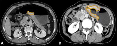 A quantitative model based on gross tumor volume of gastric adenocarcinoma corresponding to N-stage measured at multidetector computed tomography for preoperative determination of resectability: A case control study