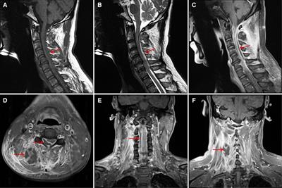 Case Report: A case of cervical spinal epidural abscess combined with cervical paravertebral soft tissue abscess