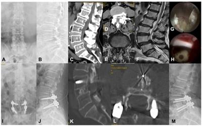 Analysis of curative effect of percutaneous coaxial large channel endoscopic lumbar interbody fusion in the treatment of degenerative lumbar spinal stenosis