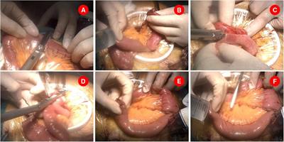 Simplified Roux-en-Y reconstruction after laparoscopic radical distal gastrectomy for gastric cancer