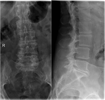 Case Report: Campylobacter fetus caused pyogenic spondylodiscitis with a presentation of cauda equina syndrome after instrumented lumbar fusion surgery