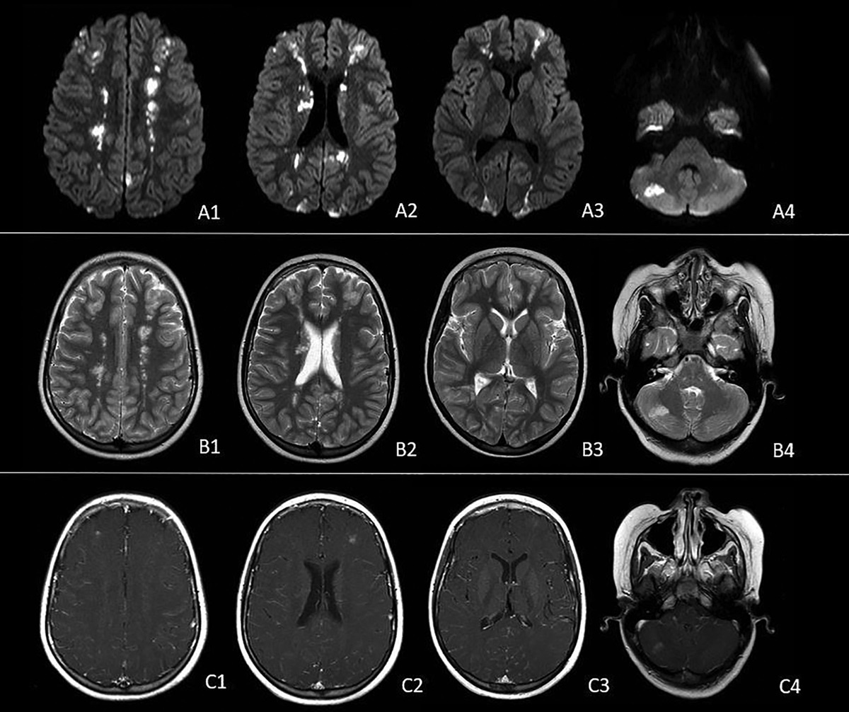 A 9-Year-old Boy With Fever, Eosinophilia, and Neurologic Symptoms