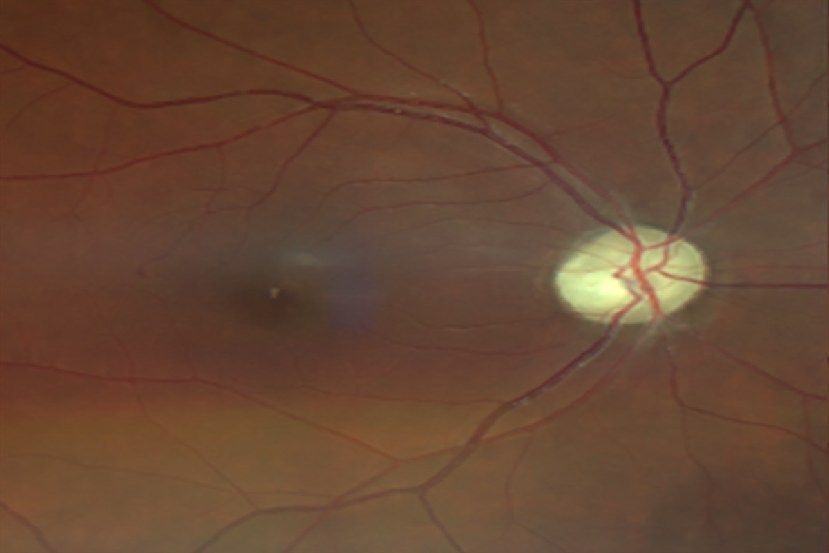 Case Report: Optic Nerve Atrophy Secondary to Sjögren Syndrome