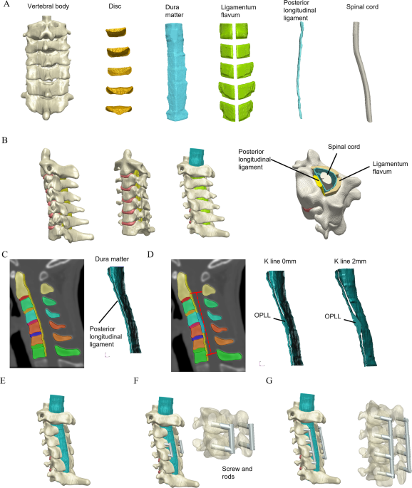 Effect of posterior decompression with and without fixation on a kyphotic cervical spine with ossification of the posterior longitudinal ligament