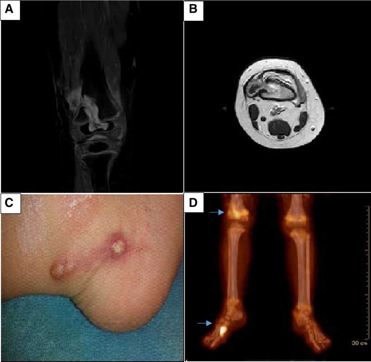 Chronic Q Fever as Recurrent Osteoarticular Infection in Children: Case Report and Literature Review