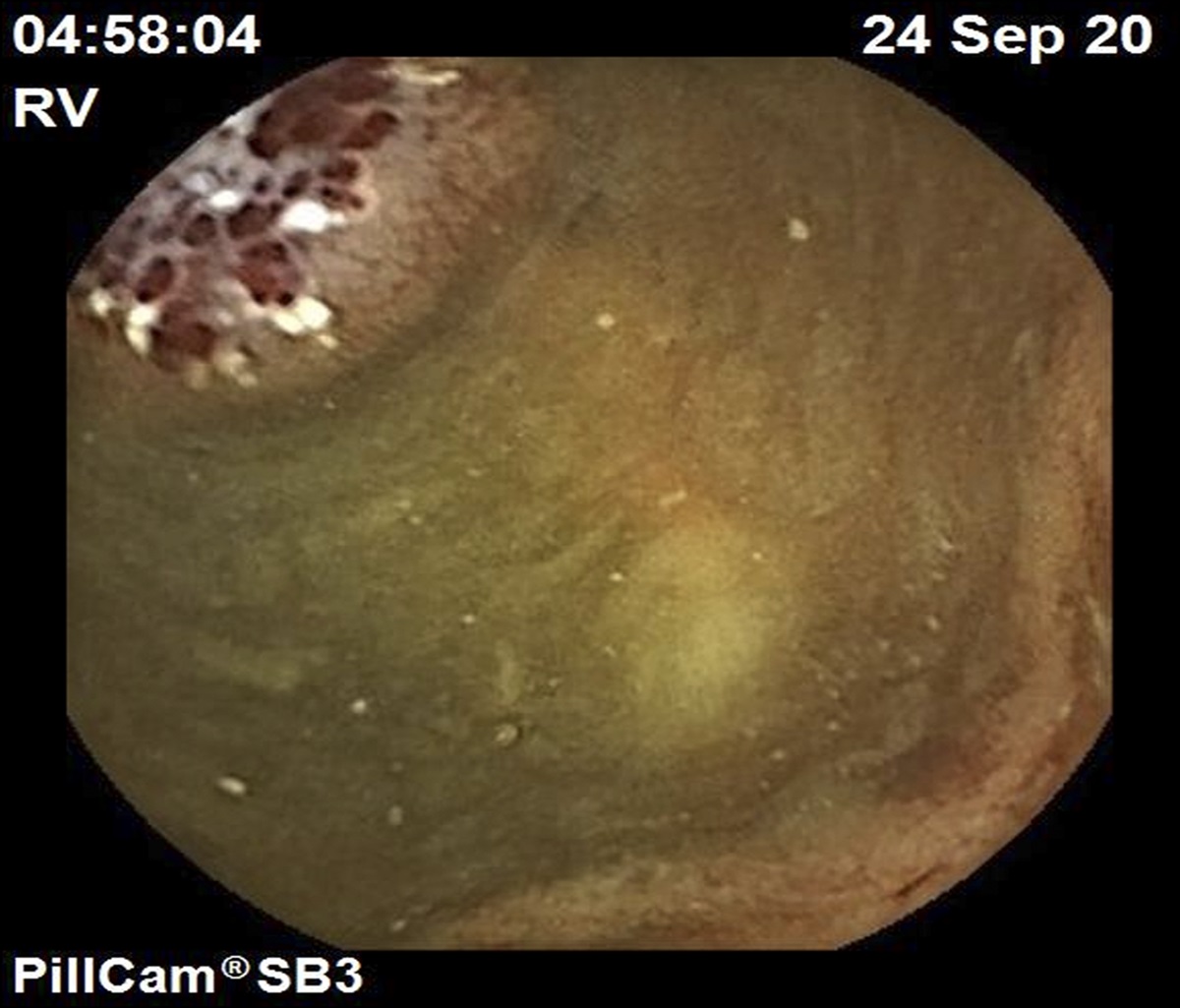 Single-Balloon-Assisted Enteroscopy With Endoscopic Mucosal Resection of a Bleeding Jejunal Lymphangioma