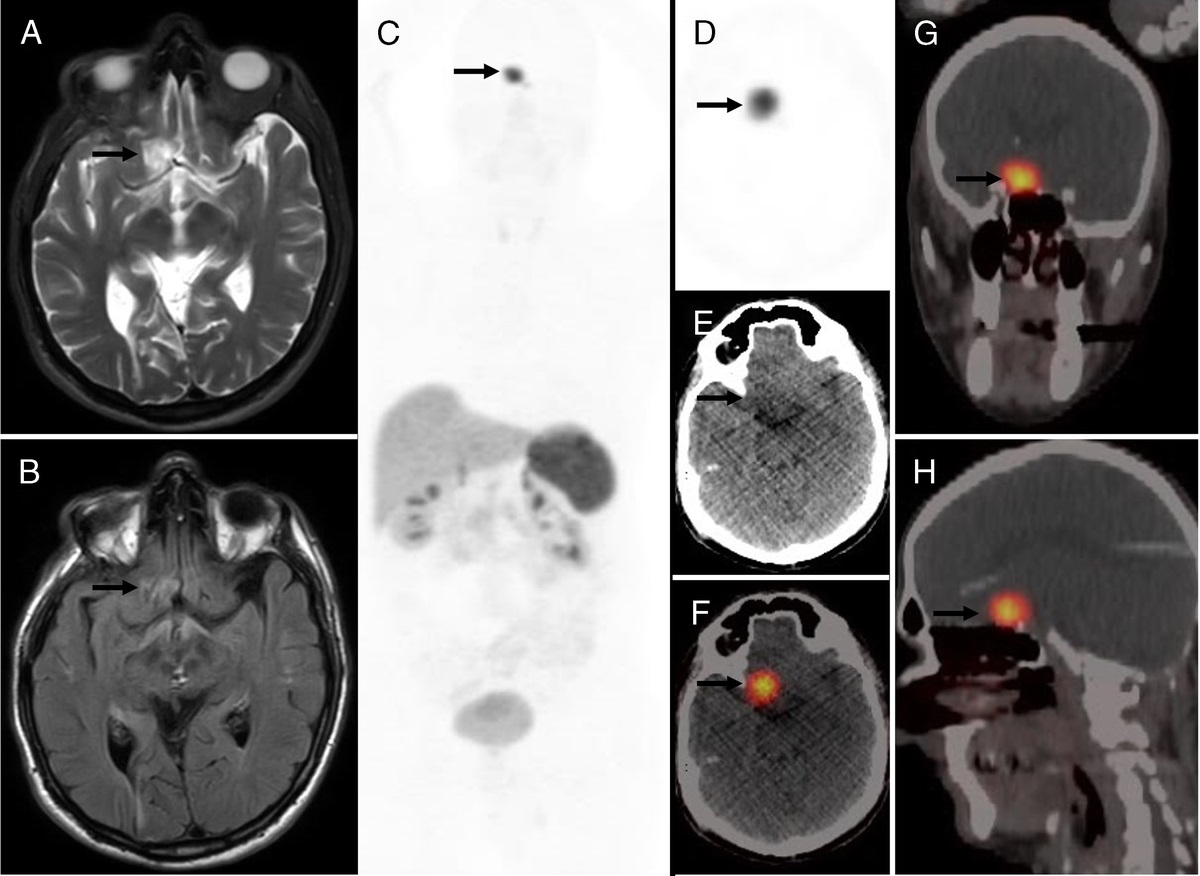 Suprasellar Hemangioblastoma on 68Ga-DOTATATE PET/CT