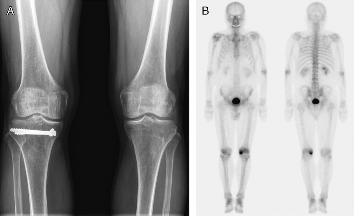 Potential Utility of SPECT/CT for Early Detection of Spontaneous Osteonecrosis of the Knee