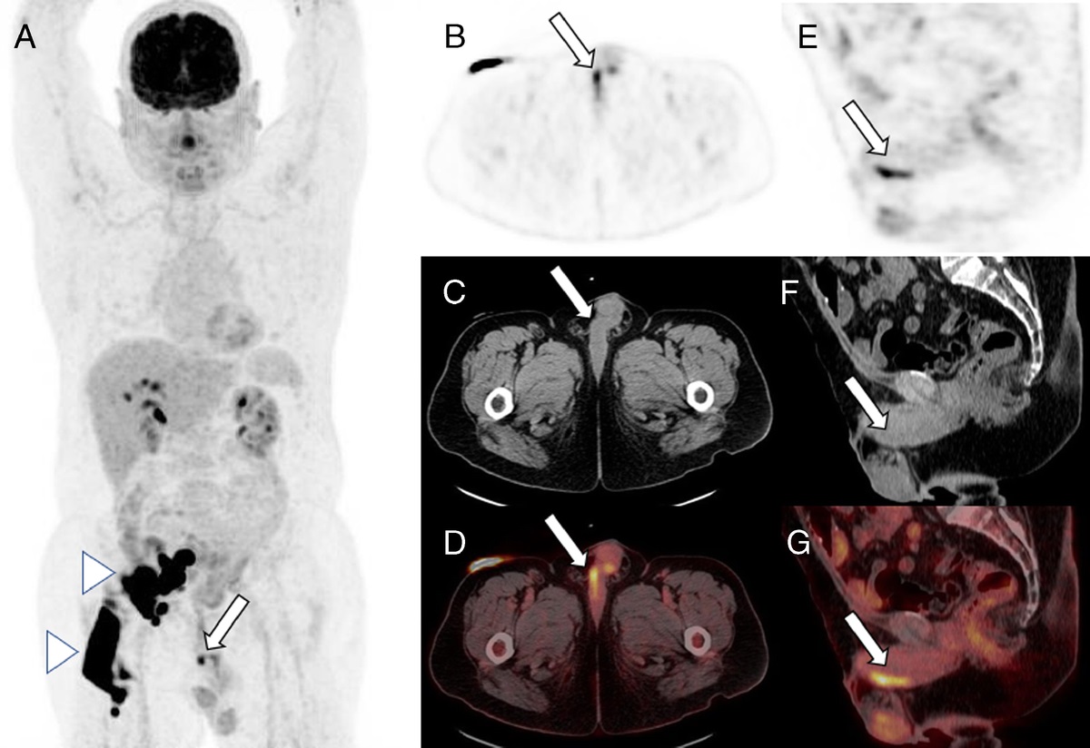 18F-FDG PET/CT in Urethral Metastases From Bladder Cancer