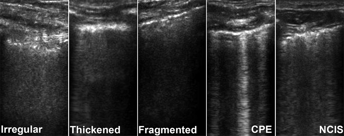 Lung Ultrasound Signs to Diagnose and Discriminate Interstitial Syndromes in ICU Patients: A Diagnostic Accuracy Study in Two Cohorts*