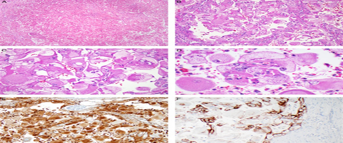 Xanthomatous Giant Cell Renal Cell Carcinoma: Another Morphologic Form of: TSC: -associated Renal Cell Carcinoma