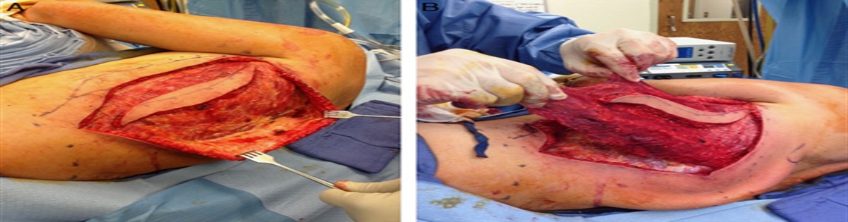 Modified Unipolar Latissimus Transfer to Restore Elbow Flexion in Musculocutaneous Nerve Palsy