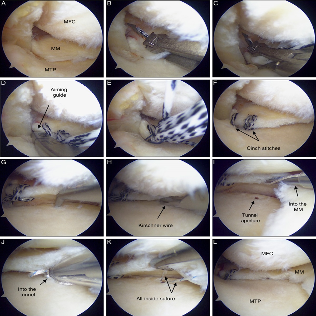 Novel Posterior Anchoring Method Associated With Medial Meniscus Posterior Root Repair