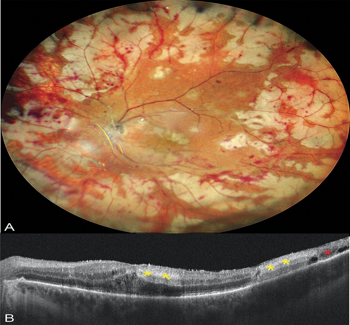 Varicella Zoster Virus and Acute Retinal Necrosis