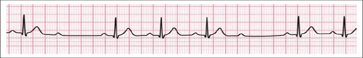 A Case of a Man with Syncope After Physical Exertion