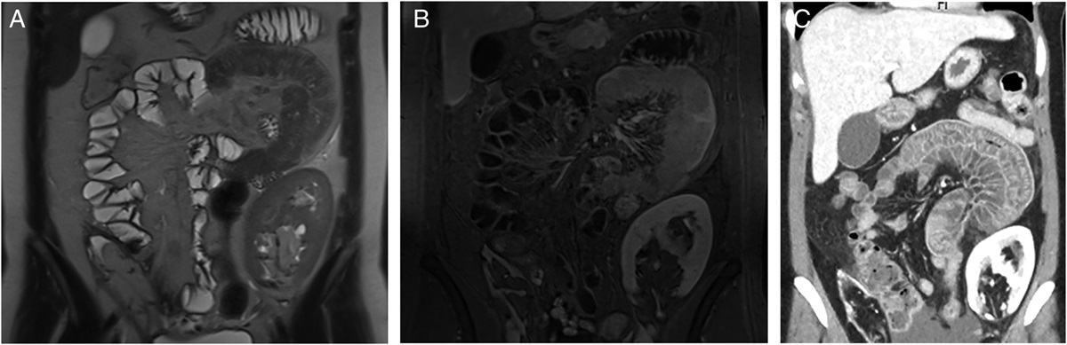Angiotensin-Converting Enzyme Inhibitor-Induced Small Bowel Angioedema: An Important Differential for Episodic Enteritis