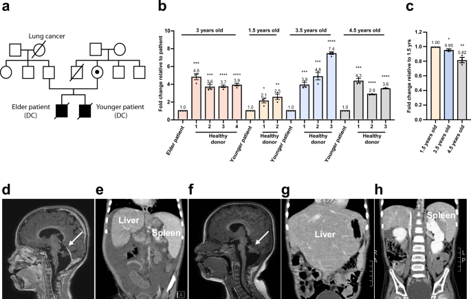 A missense variant in the nuclear localization signal of DKC1 causes Hoyeraal-Hreidarsson syndrome