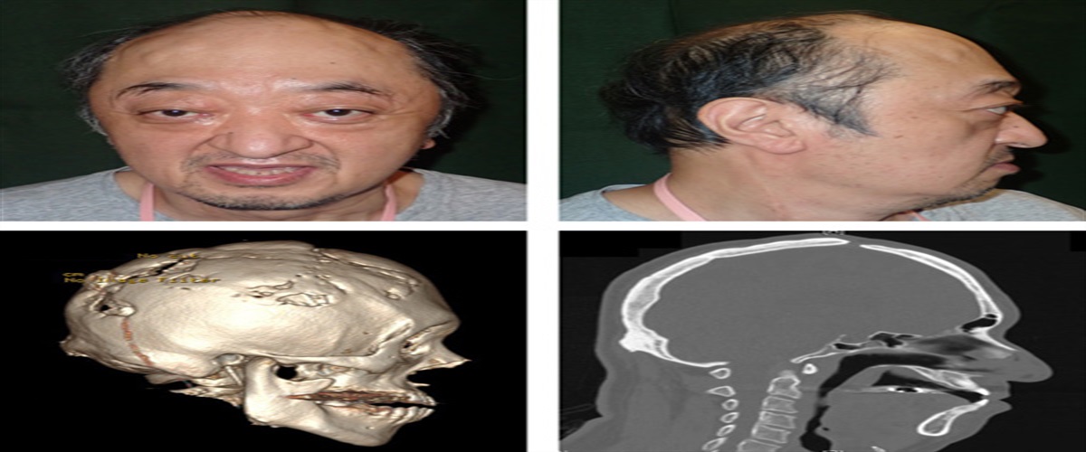 An Elderly Patient With Crouzon Syndrome Treated With Monobloc Distraction