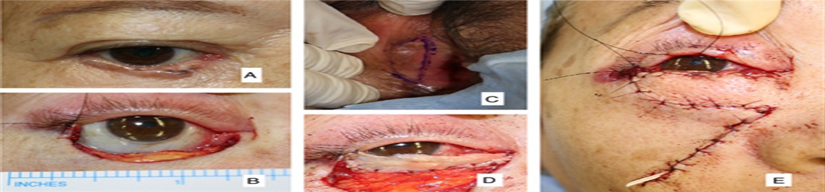 Labia Minora Transplantation With Local Flap for Reconstruction of Full-Thickness Defect of the Lower Eyelid