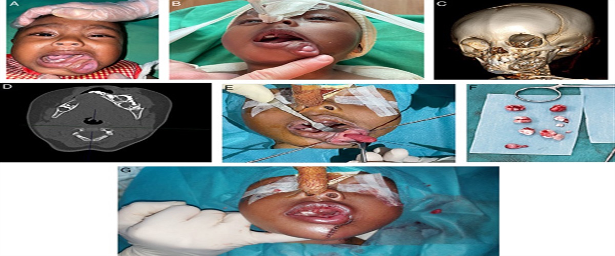 “Oris Duplicatio”—Duplication of the Oral Cavity a Rare Malformation in a 10-Month-Old Child: State of the Science and Management