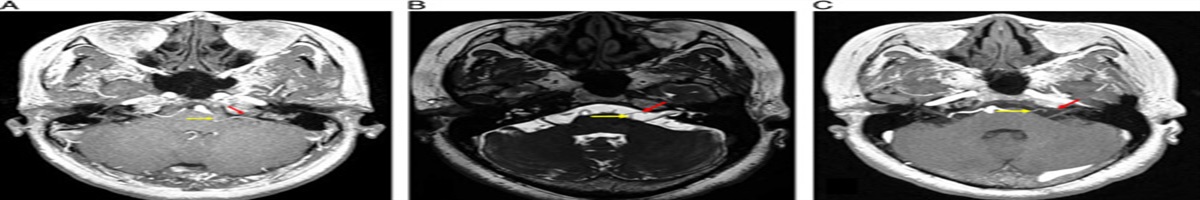 Hemifacial Spasm Caused by Distal Neurovascular Compression Confirmed by Lateral Spread Response Monitoring