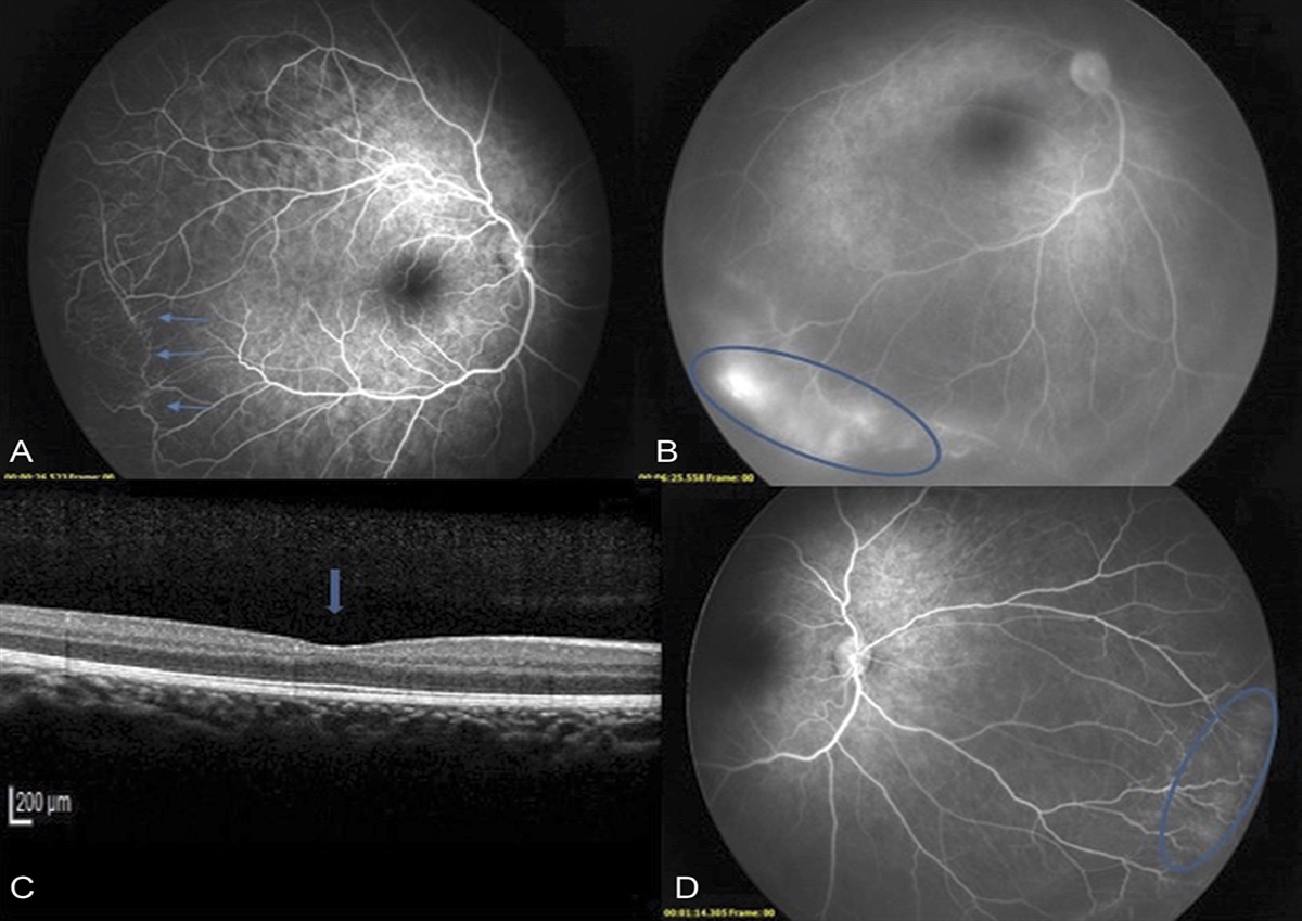 LONG-TERM EFFECTS OF ANTI-VEGF MONOTHERAPY FOR RETINOPATHY OF PREMATURITY ON THE RETINAL AND REFRACTIVE DEVELOPMENT OF EYE