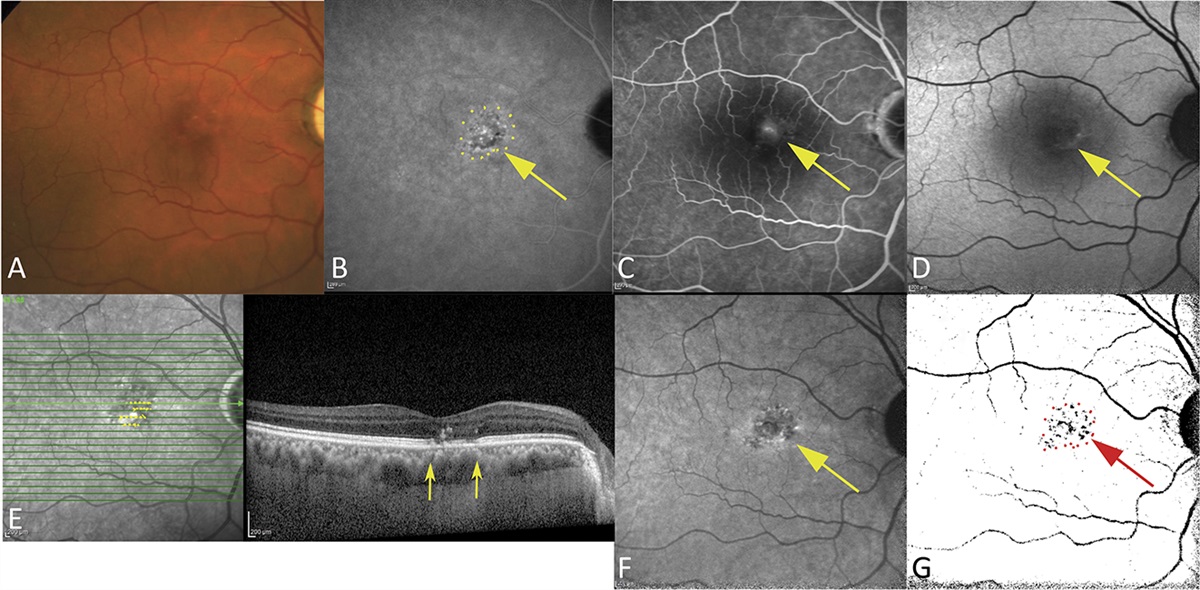 LOCATIONAL AGREEMENT OF NEAR-INFRARED AUTOFLUORESCENCE WITH CHOROIDAL VASCULAR HYPERPERMEABILITY IN CENTRAL SEROUS CHORIORETINOPATHY