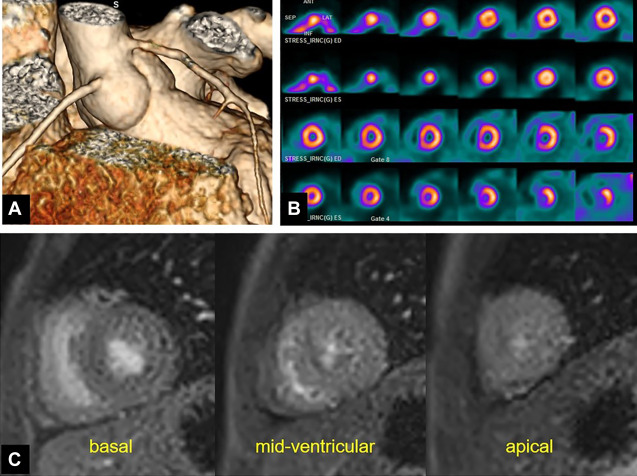 Anomalous Coronary Arteries