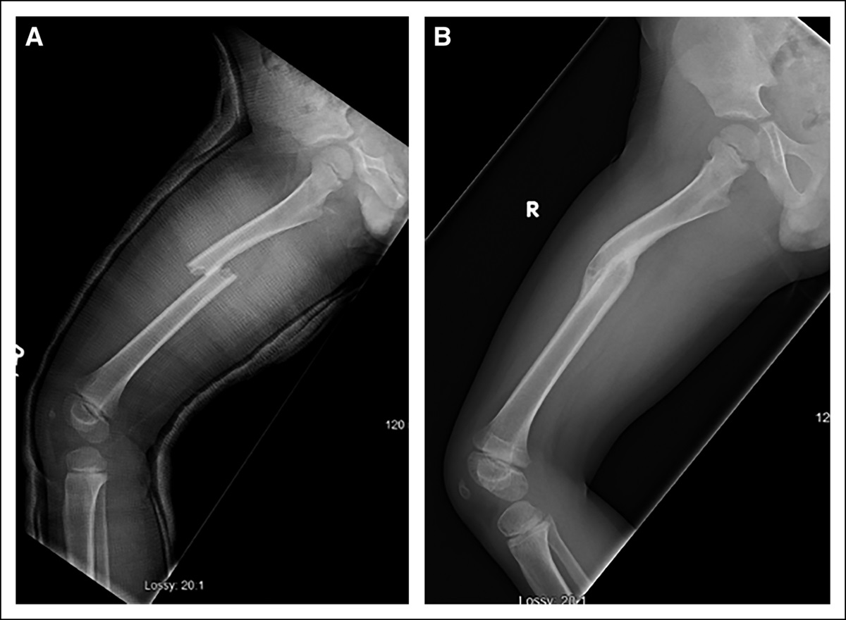 Treatment of Pediatric Femoral Shaft Fractures