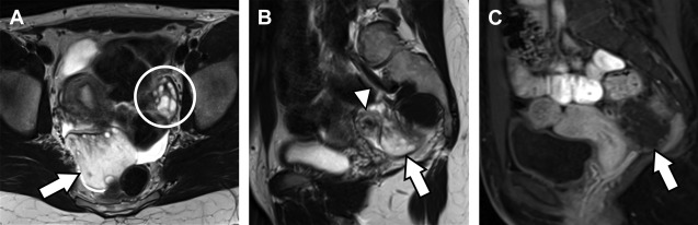 Magnetic Resonance Imaging of Acute Adnexal Pathology