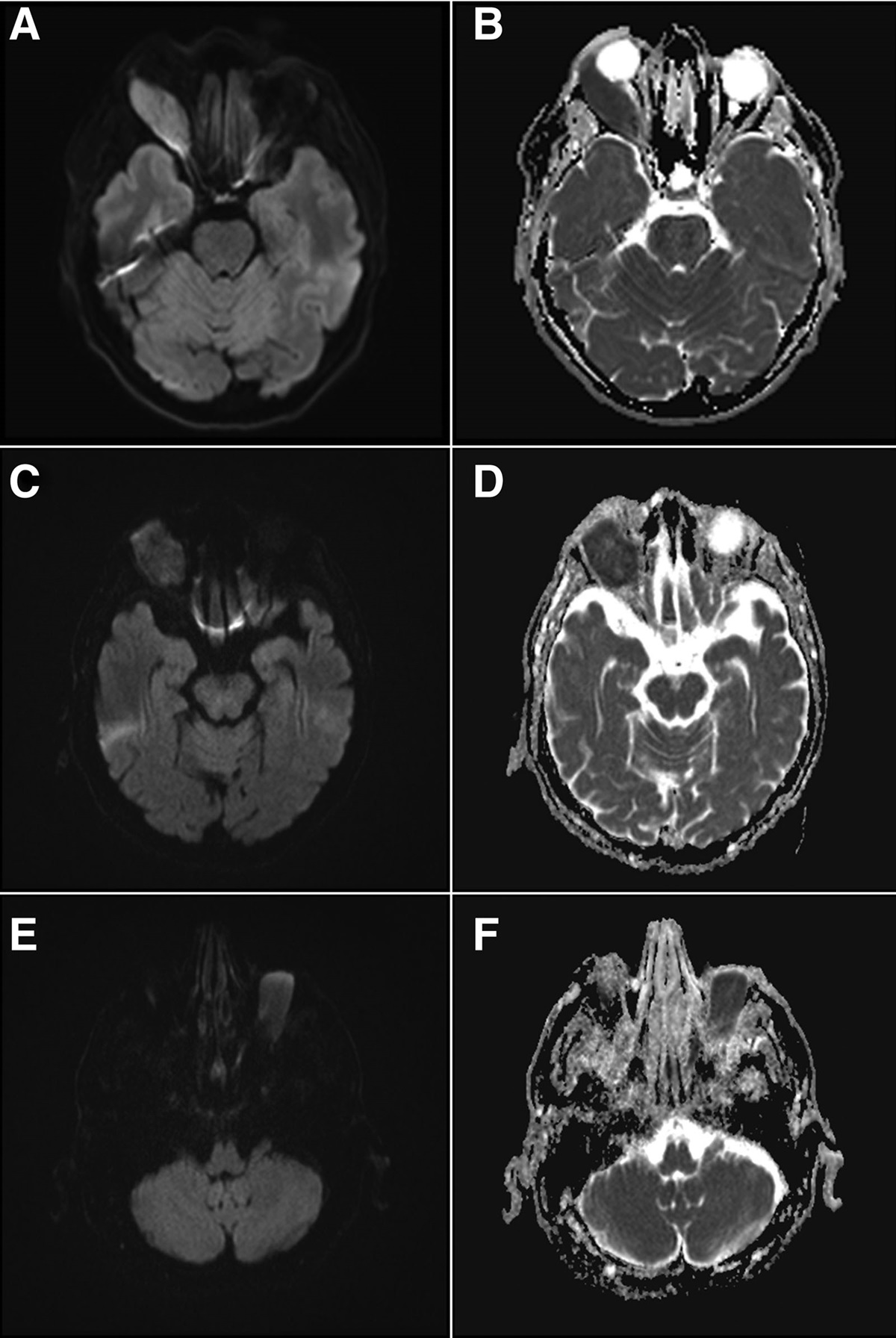 Diagnostic Utility of Diffusion-Weighted Imaging and Apparent Diffusion Coefficient for Common Orbital Lesions: A Review
