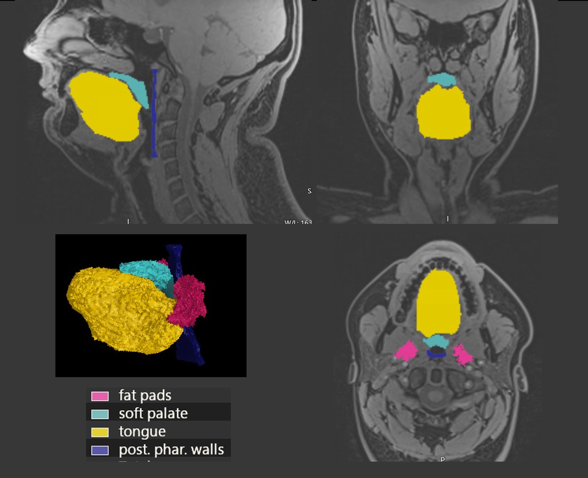 Assessment of Fat Fractions in the Tongue, Soft Palate, Pharyngeal Wall, and Parapharyngeal Fat Pad by the GOOSE and DIXON Methods